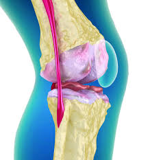 Остеоартрит (артроз) коленного сустава