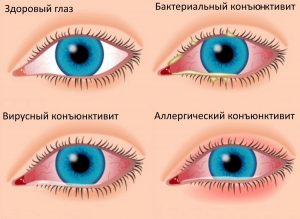 https://ochistis.ru/allergicheskij-konyunktivit-simptomy-i-lechenie/
