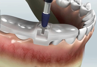 Хирургические шаблоны в стоматологии