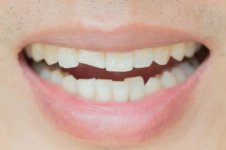 Важность реставрации и восстановления зубов