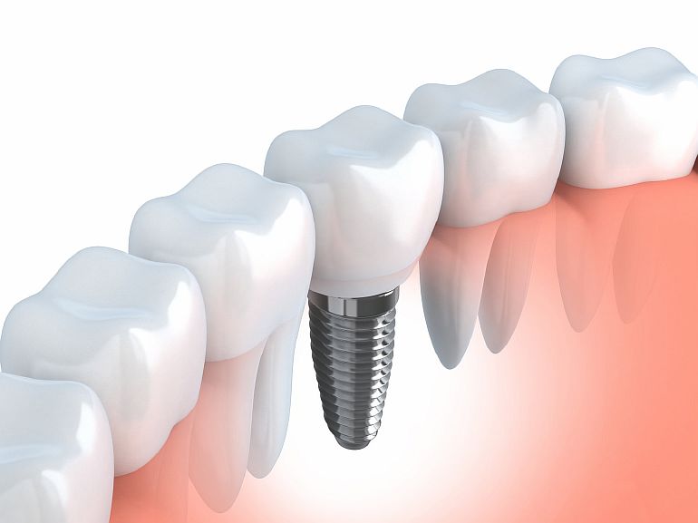 Важность реставрации и восстановления зубов
