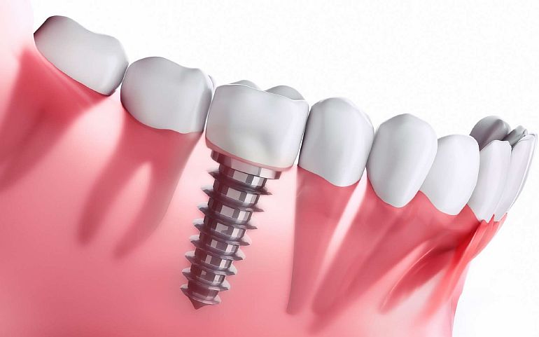 Протезирование: типы зубных протезов