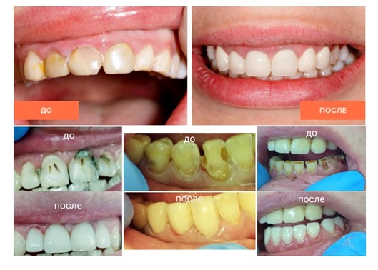 Реставрация передних зубов до и после