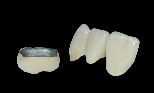 металлокерамическая зубная коронка